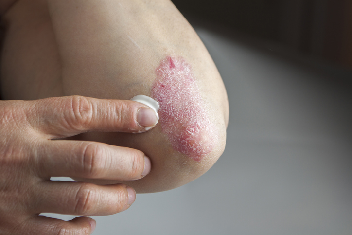 Psoriasis on elbow