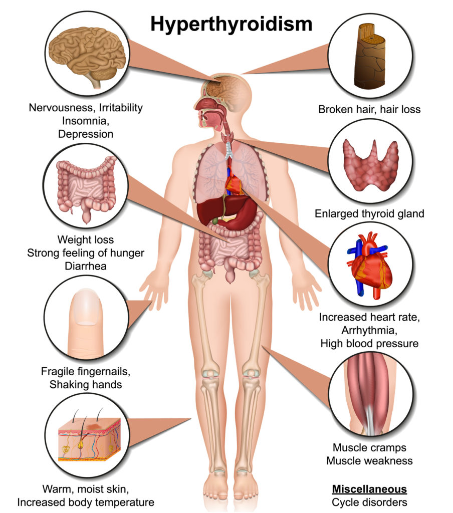 Hyperthyroidism 