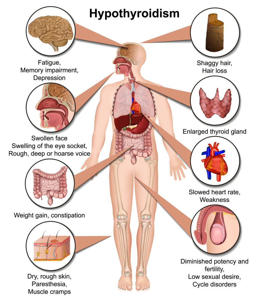 Hypothyroidism